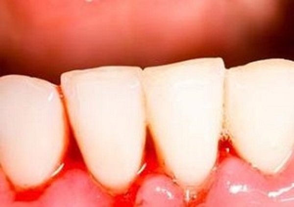 牙龈出血的原因是什么？怎么治疗？